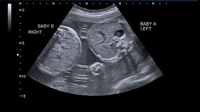 ultrasound of twins