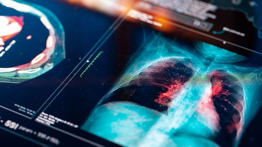 Lung scan