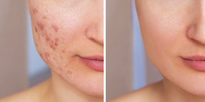 adult acne dermatologists explain acne treatments and reveal more about the skin condition