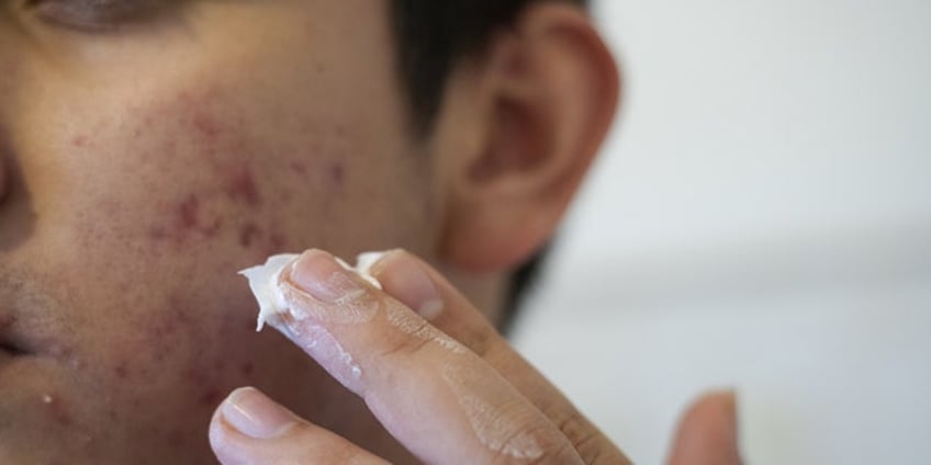 adult acne dermatologists explain acne treatments and reveal more about the skin condition