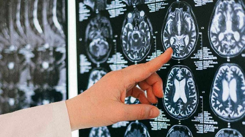A doctor’s hand pointing at a brain scan.