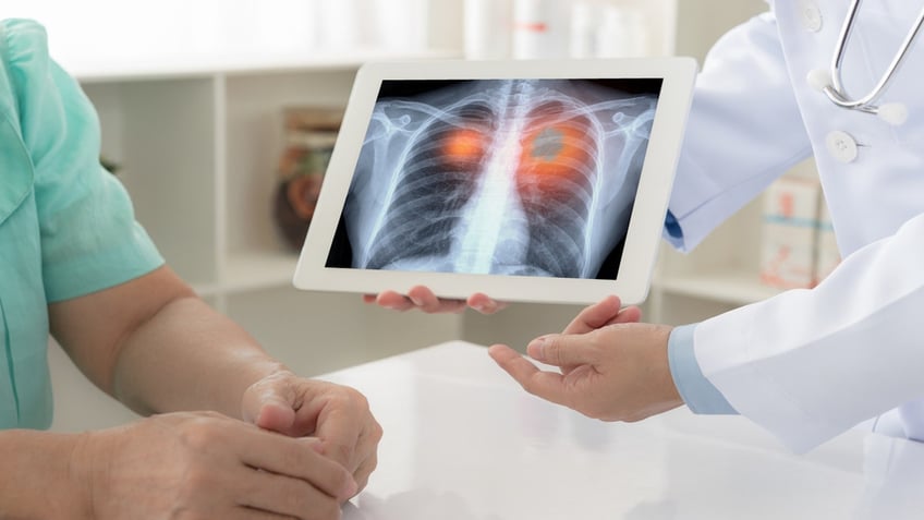 ai model could help predict lung cancer risks in non smokers study finds significant advancement