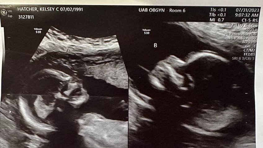 alabama woman with two uteruses is pregnant with twins one in each womb 1 in 50 million chance
