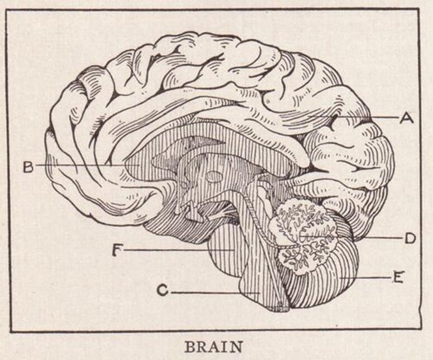 alzheimers could be a white matter disease not gray