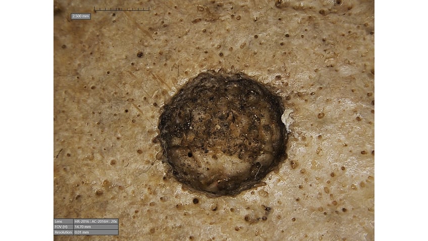 A lesion inside skull 236