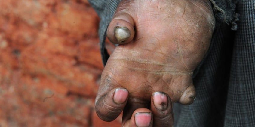 as leprosy cases rise in florida what you must know about the infectious disease