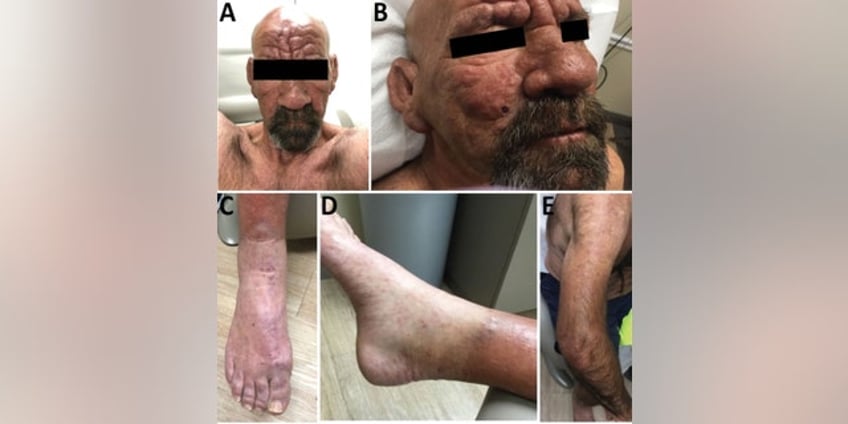 as leprosy cases rise in florida what you must know about the infectious disease