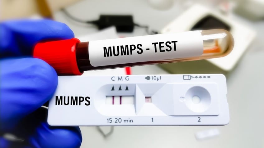 Mumps test