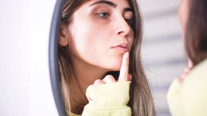 Woman with cold sore