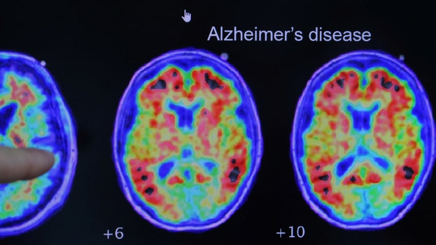 ask a doc how can i reduce the risk of alzheimers disease here are 3 tips