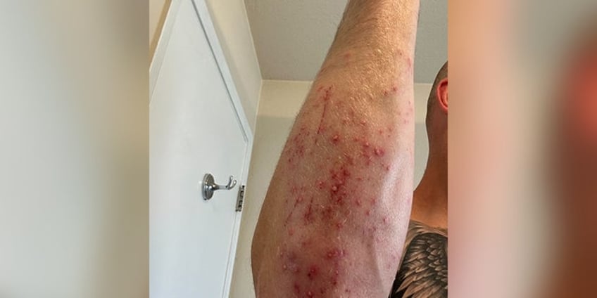 athletes break out in rashes fever after tough mudder race