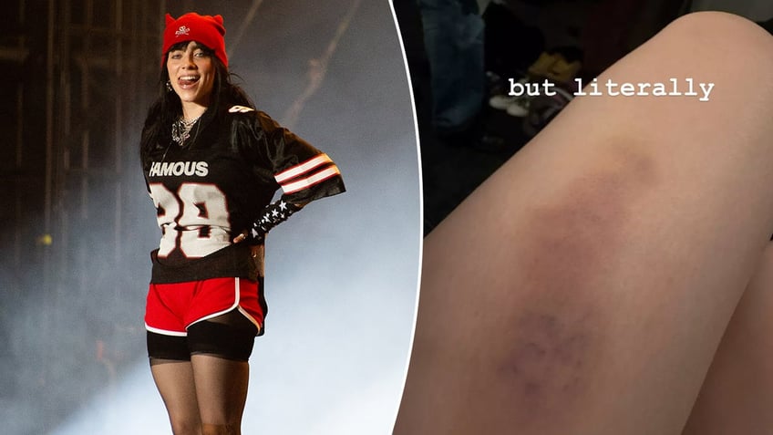 billie eilish bruise