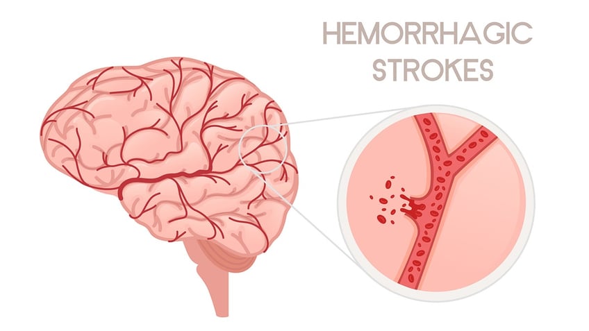 hemorrhagic stroke illustration