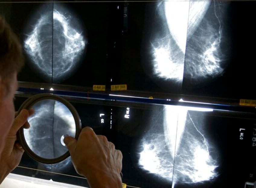 breast cancer survivors may not need so many mammograms after surgery uk study suggests