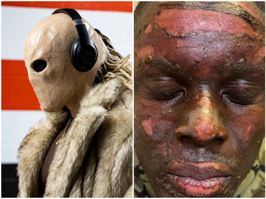 browns david njoku played against ravens after bonfire burned his face and hands he is another species