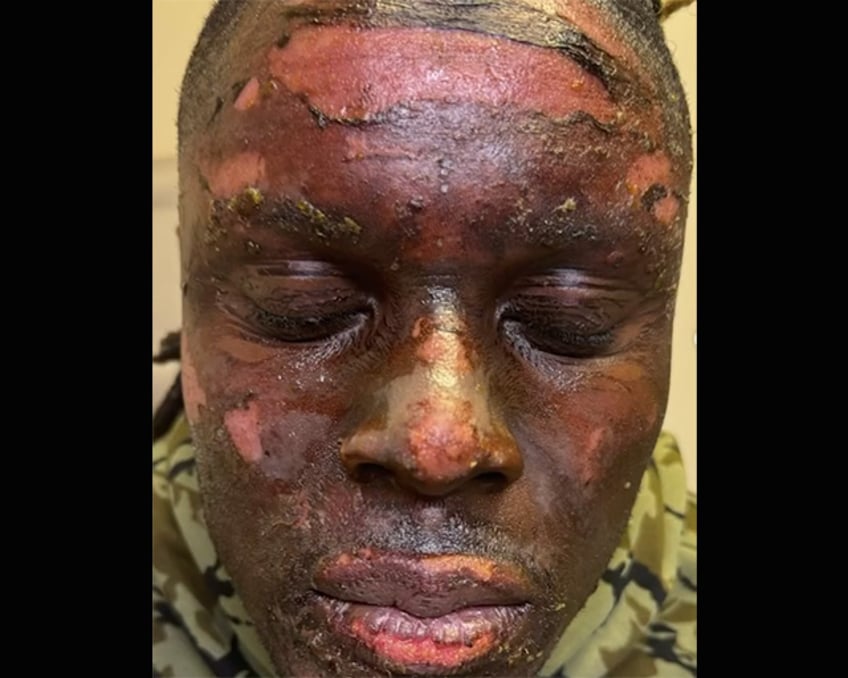 browns david njoku played against ravens after bonfire burned his face and hands he is another species