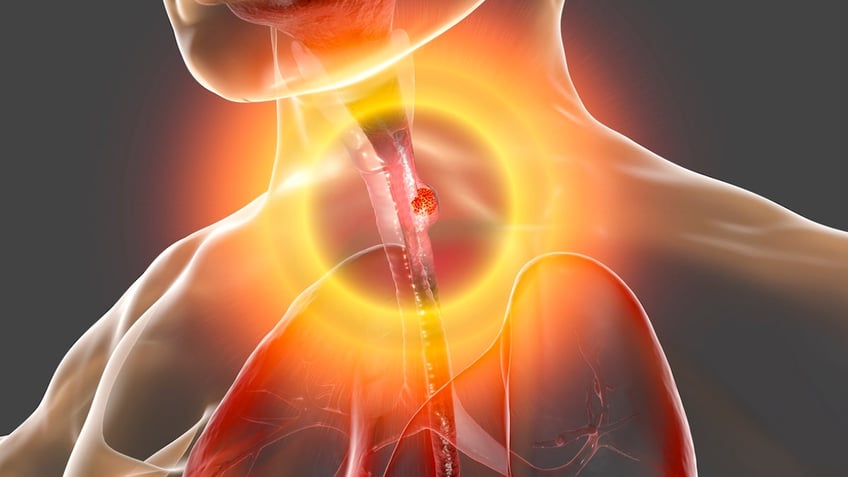 Esophageal cancer