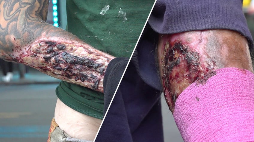 Tranq users flesh-eating wounds scab over or ooze