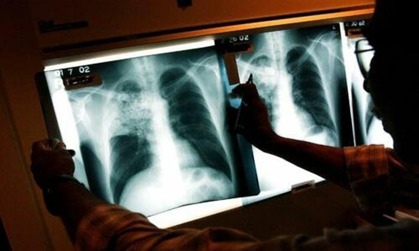 deadly lung disease cases surge to 10 year high children most affected cdc