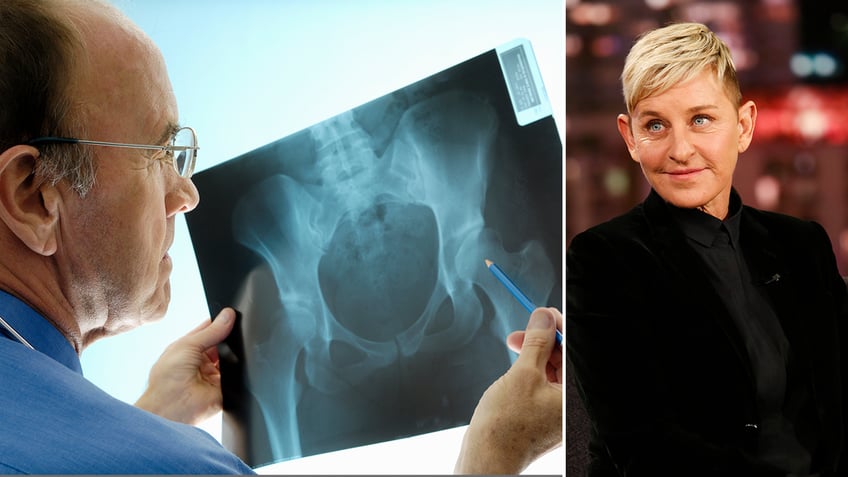 split image of an x-ray of a hip and Ellen DeGeneres