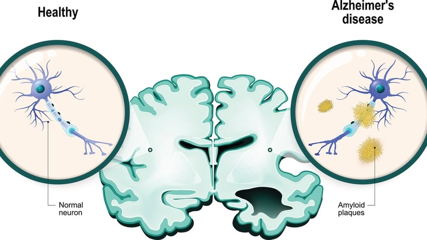 fasting could reduce signs of alzheimers disease studies suggest profound effects