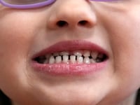 FDA and RFK Jr. aim to remove fluoride supplements used to protect kids’ teeth