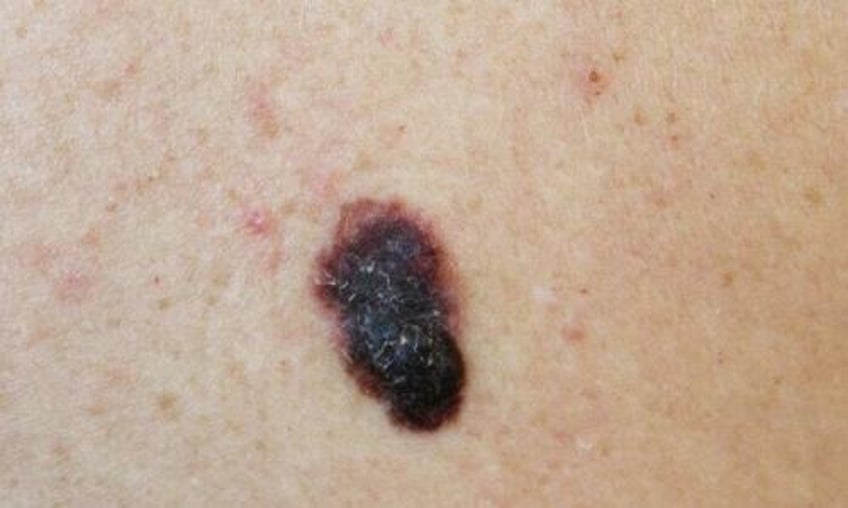 fda approves 1st t cell therapy for melanoma