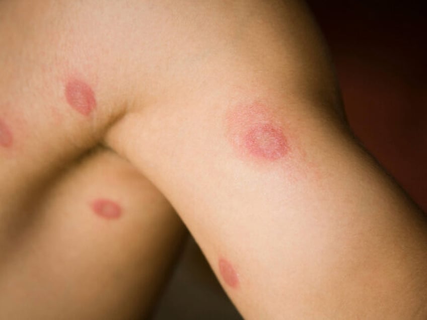 Human ringworm - stock photo