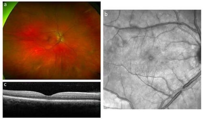 first case of white dot syndrome emerged after covid 19 vaccine and subsequent infection study shows