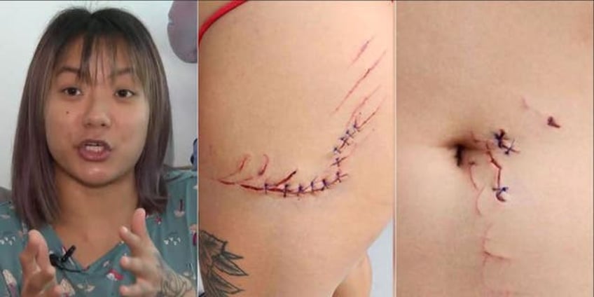 florida woman bitten by shark off gulf coast receives 14 stitches swam the fastest i ever swam