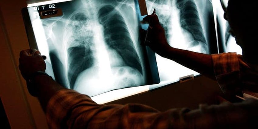 indiana hospital notifies around 500 patients they may have been exposed to tuberculosis