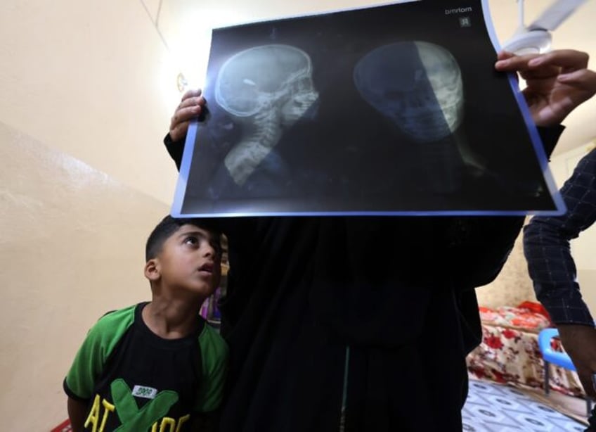 Four-year-old Mohamed looks at the X-ray showing the bullet lodged in his head