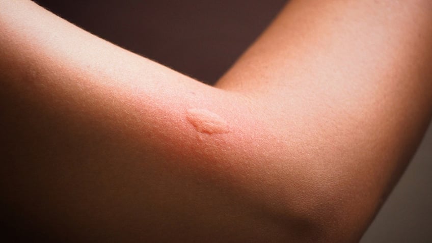 is it just a mosquito bite or could it be skeeter syndrome heres what to know