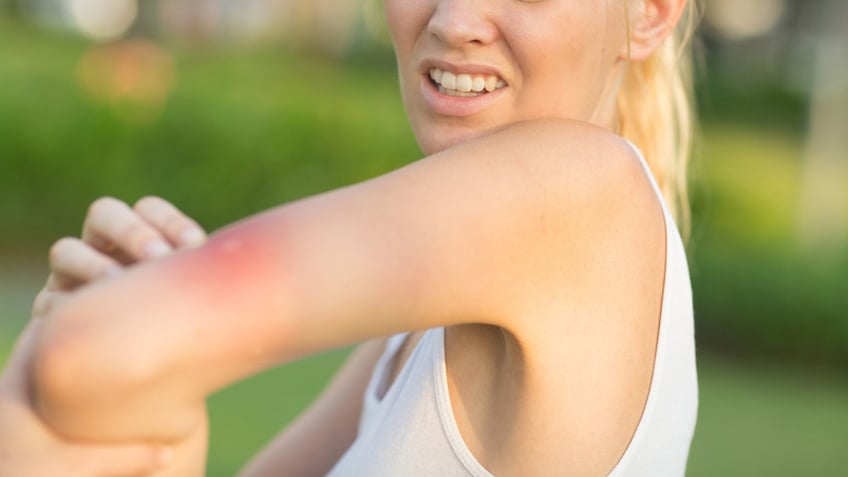 is it just a mosquito bite or could it be skeeter syndrome heres what to know