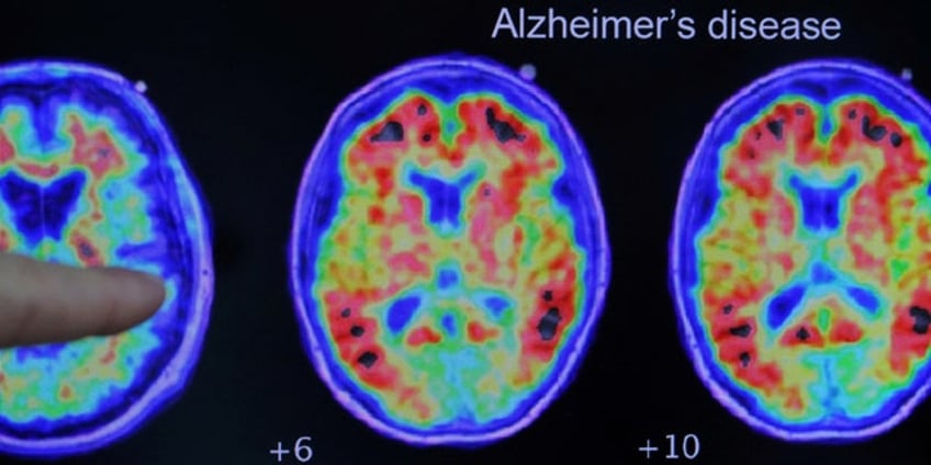 japanese health ministry panel recommends approval of alzheimers treatment leqembi