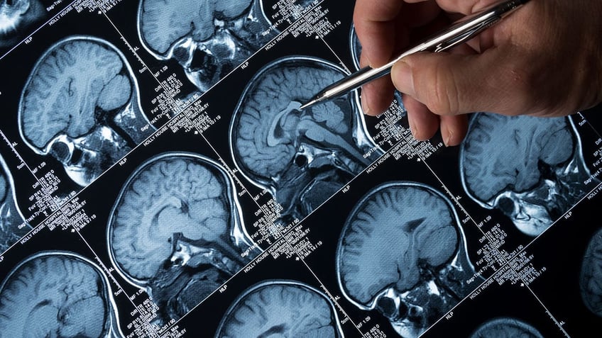 man shocked to discover source of headaches for 5 months is pair of chopsticks inside his skull