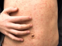 Measles outbreak continues in Texas, cases double: investigation underway