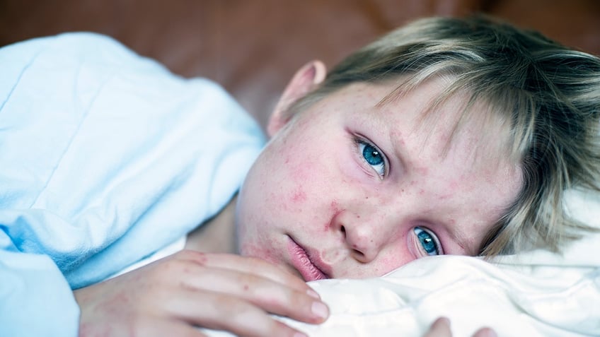 sick little boy fighting measles infection