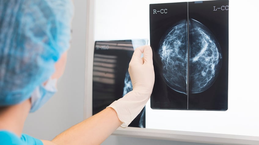 missing mammograms over 20 of women dont follow breast cancer screening guidelines study says