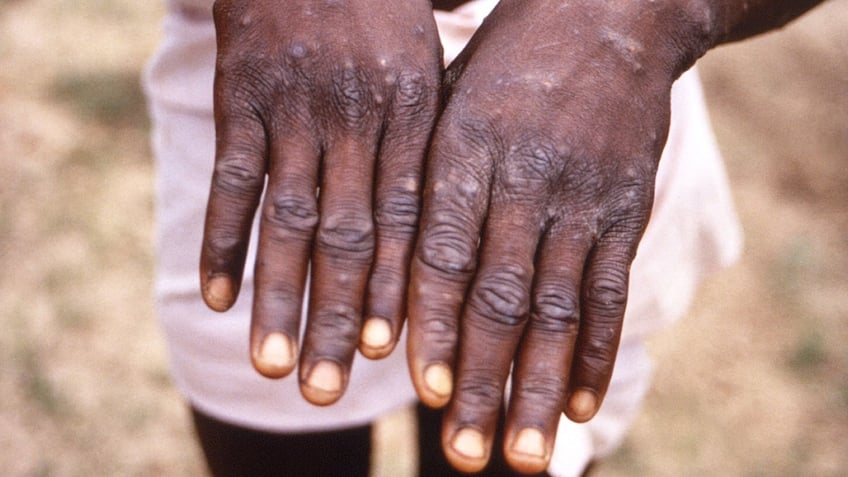 Monkeypox virus health