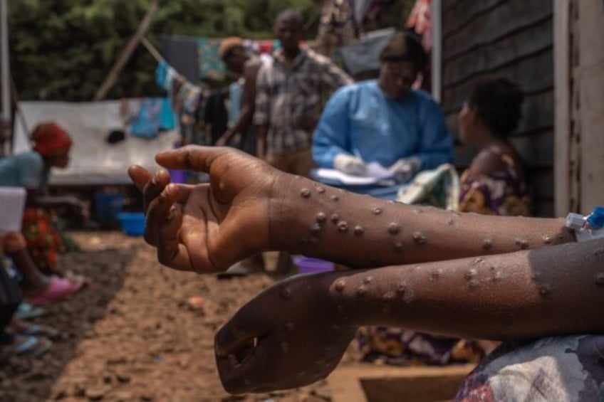 The first mpox vaccines were delivered two days ago in Rwanda