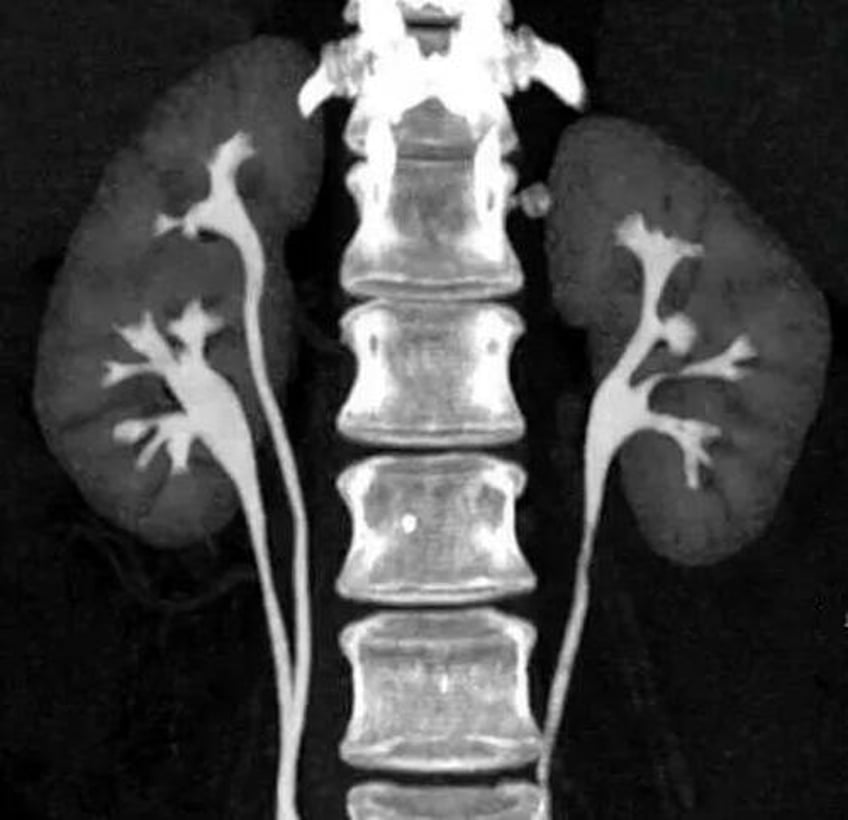 new zealand fudged the data on how kidneys fare after covid vaccines