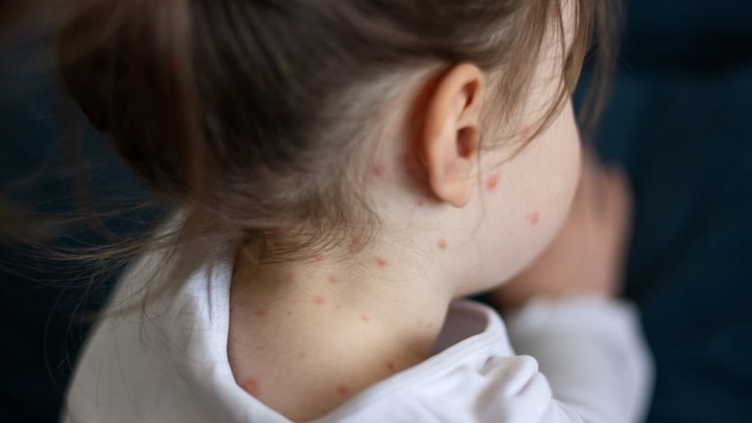 Child with measles