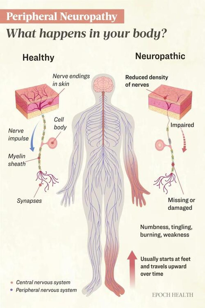 peripheral neuropathy symptoms causes treatments and natural approaches