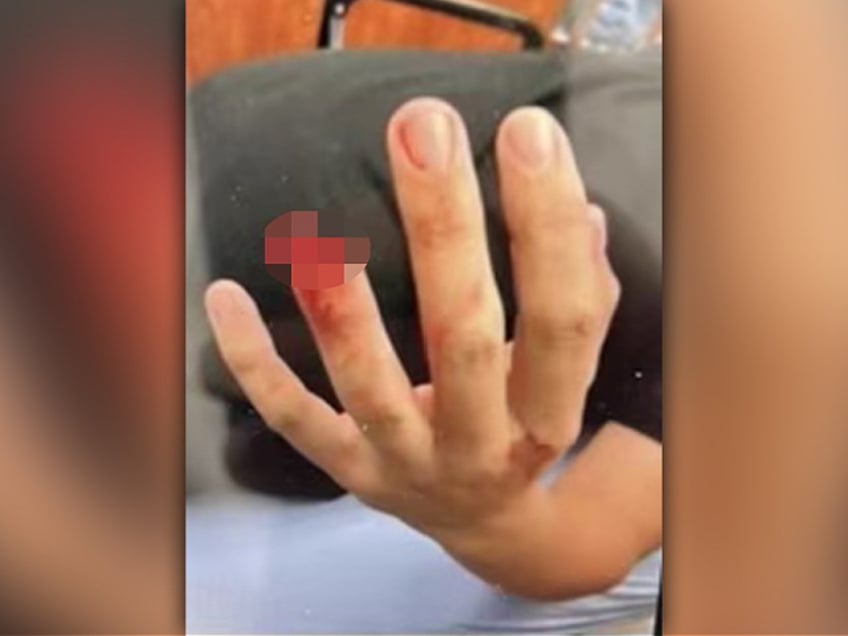 photo police say illegal immigrant bit off chunk of nypd officers finger