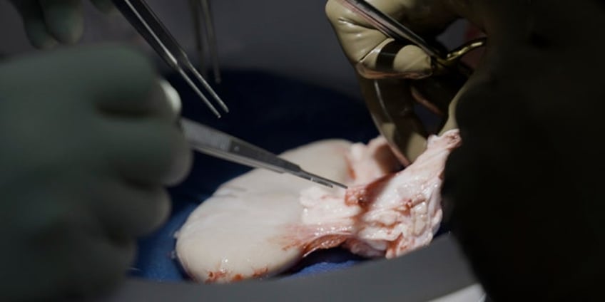 pig kidney works in body of brain dead man for over a month a giant step in animal human organ transplants