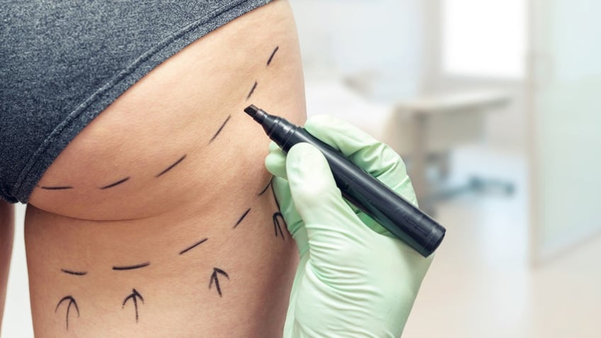 Surgeon marking butt for surgery