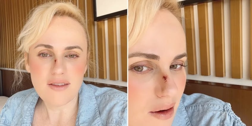 rebel wilson gets stitches after being injured by prop gun on movie set