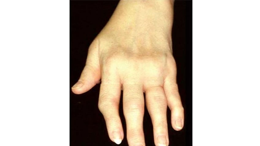 Hand with rheumatoid arthritis