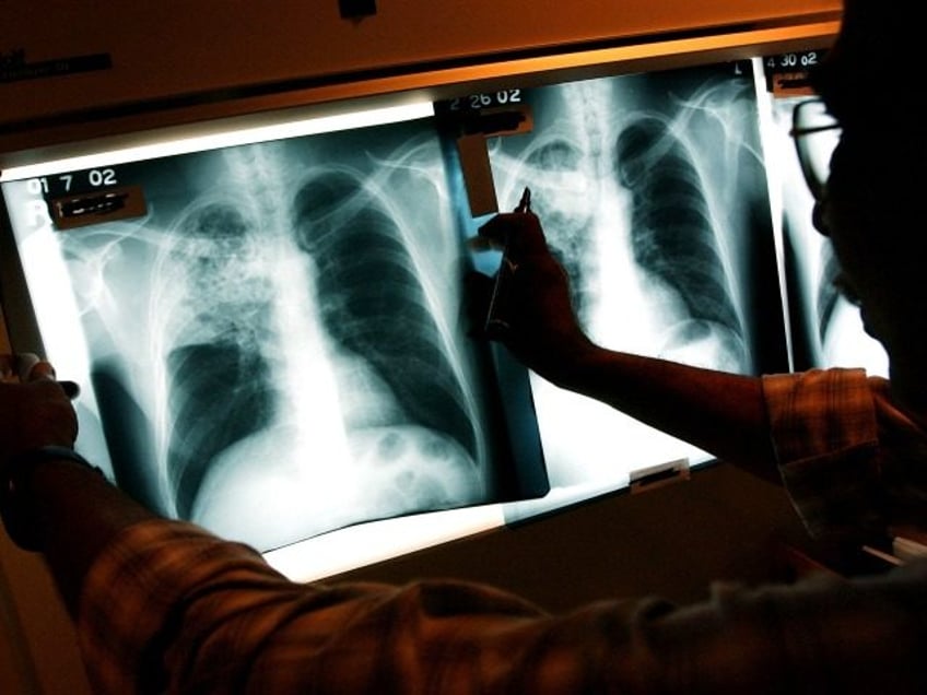 seattle hospital worker with active tb may have exposed 140 cancer patients to the disease